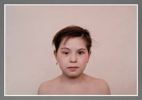 Children Who Have Had Thyroid Operation (From Chernobyl Series)