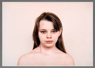 Children Who Have Had Thyroid Operation (From Chernobyl Series)