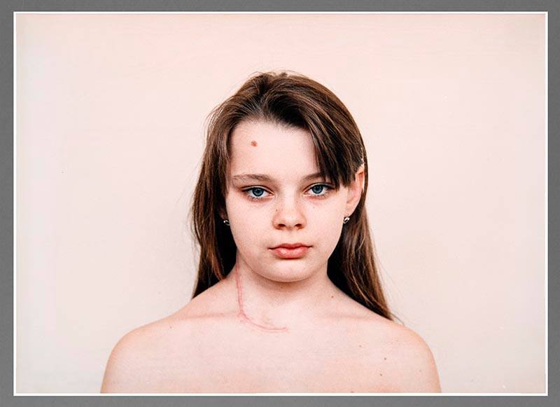 Children Who Have Had Thyroid Operation
