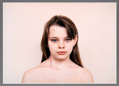 Children Who Have Had Thyroid Operation