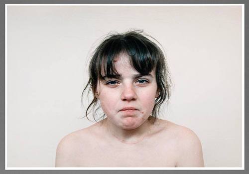 Children Who Have Had Thyroid Operation